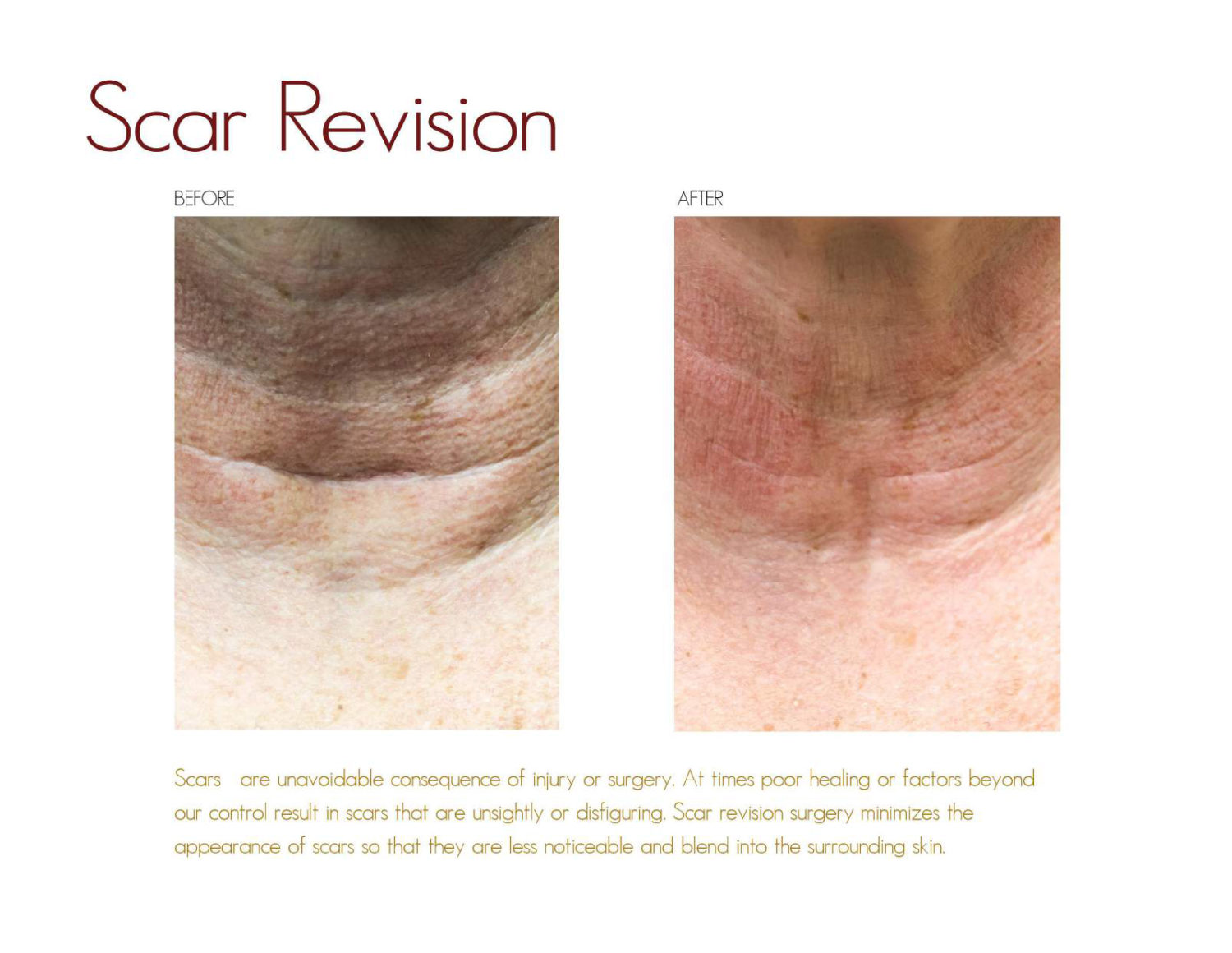 Scar Revision Drake Presti Ent Surgical Associates